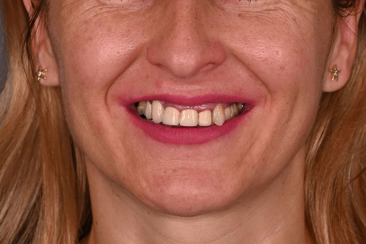 Pacient Clinica Dr. Alin Odor - Rezultat Implantologie